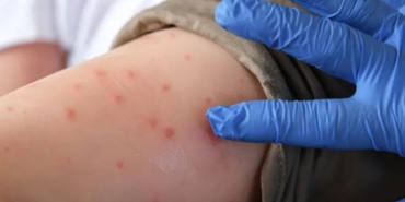 Çin'den bir virüs alarmı daha: Bir kişide Chikungunya çıktı, 8 bin kişi riskli ilan edildi 1 cinden-bir-virus-alarmi-daha-bir-kiside-chikungunya-cikti-8-bin-kisi-riskli-ilan-1faIXD7L.jpg
