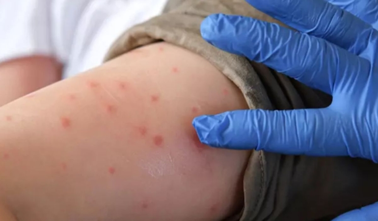 cinden-bir-virus-alarmi-daha-bir-kiside-chikungunya-cikti-8-bin-kisi-riskli-ilan-1faIXD7L.jpg
